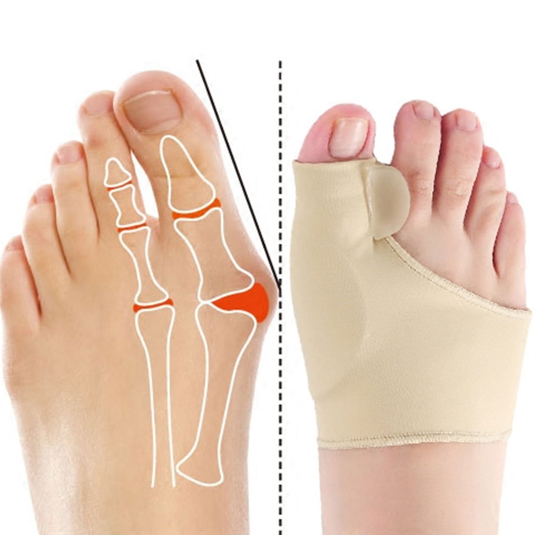 Correcteur d'oignon Coussin en Gel - 1 PAIRE